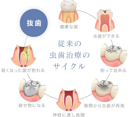 従来の虫歯治療のサイクル
