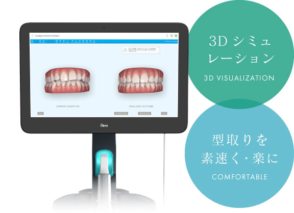 3Dシミュレーション 型取りを素速く・楽に