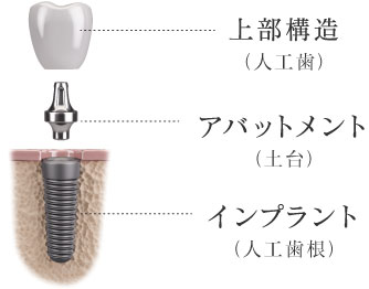 上部構造(人工歯)アバットメント(土台)インプラント(人工歯根)