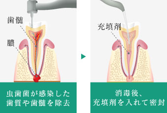 虫歯菌が感染した歯質や歯髄を除去 消毒後、充填剤を入れて密封