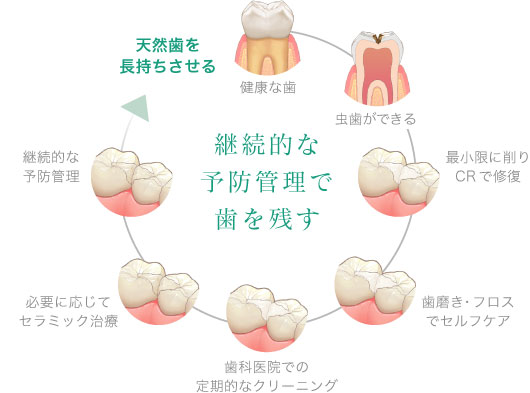 継続的な予防管理で歯を残す