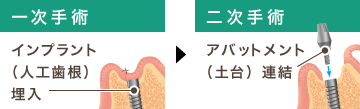 インプラント（人工歯根）埋入 アバットメント（土台）連結