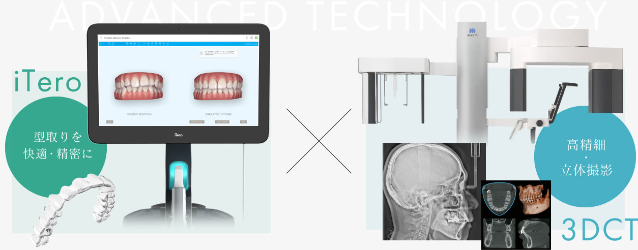 iTero 型取りを快適・精密に 3DCT 高精細・立体撮影