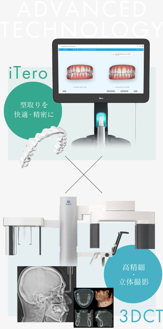 iTero 型取りを快適・精密に 3DCT 高精細・立体撮影