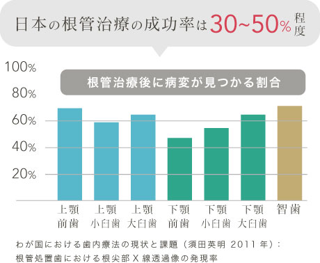 日本の根管治療の成功率は30~50%程度
