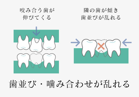 咬み合う歯が伸びてくる 隣の歯が傾き歯並びが乱れる 歯並び・噛み合わせが乱れる